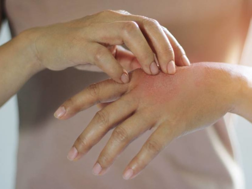 How to deal with eczema: Does skipping seafood help? Are essential oils effective?