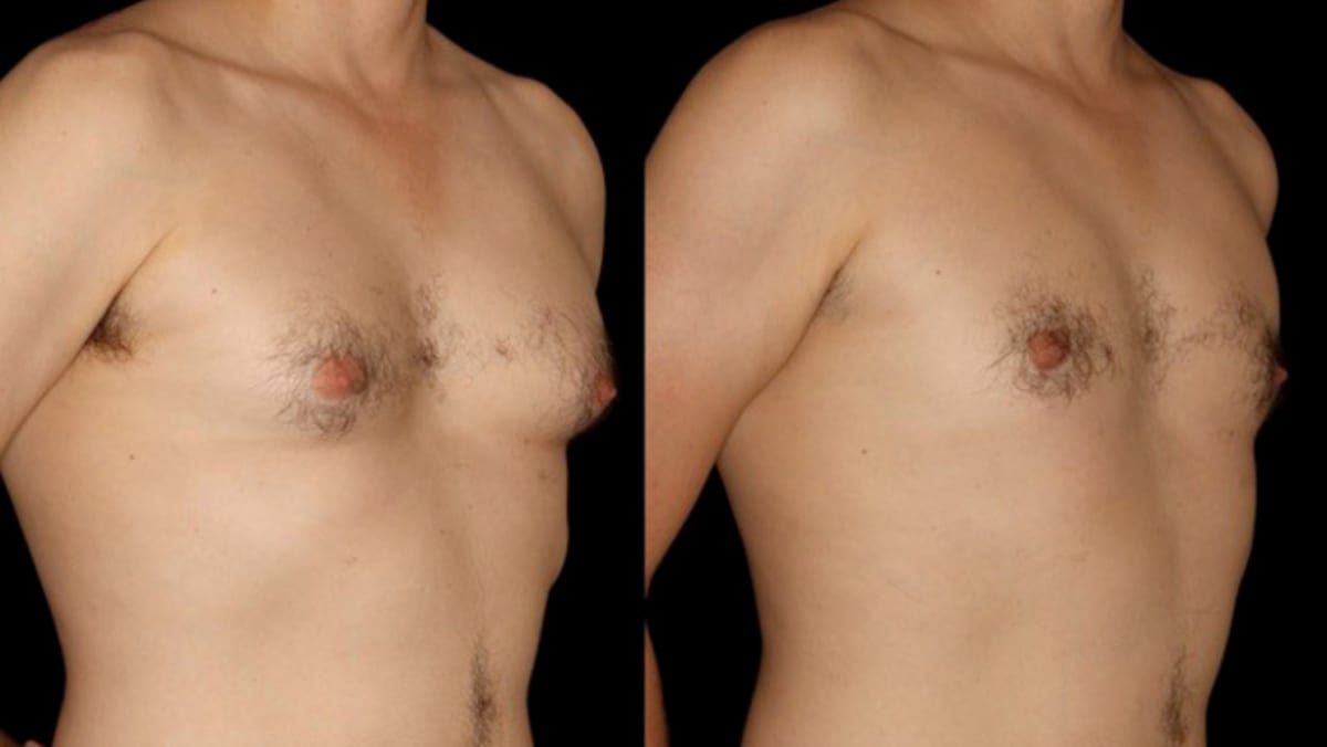 Puffy Nipples in Men, How to Get Rid of Man Boobs, Gynecomastia, Chest Fat