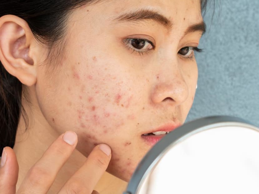 Antibiotic deals for pimples