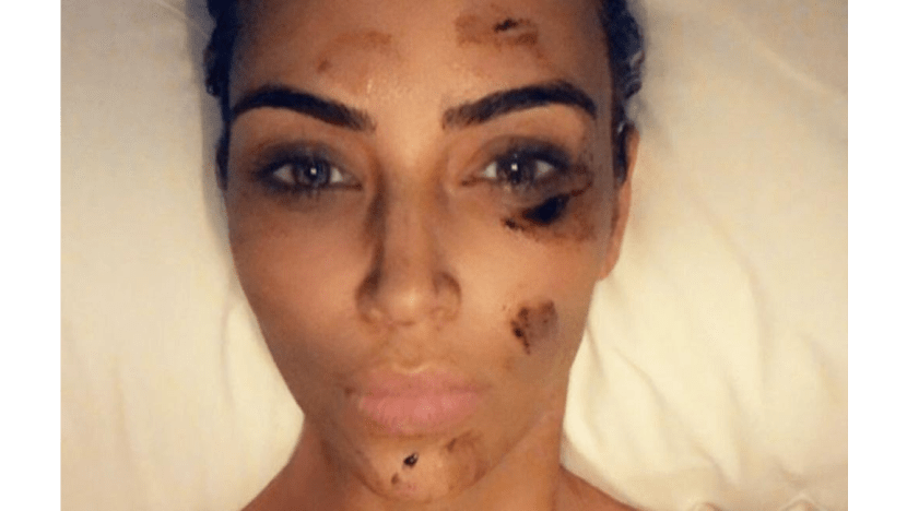 Kim Kardashian West's psoriasis flares up again Kim Kardashian West's psoriasis flares up again