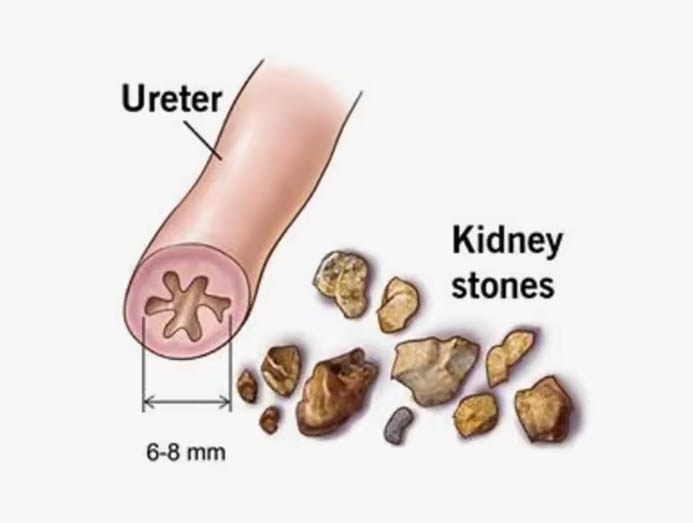 Can Rollercoaster Rides Help You Pass Out Kidney Stones
