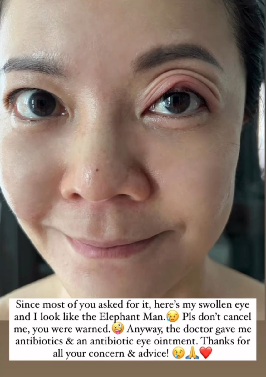 Michelle Chung tiene un ojo hinchado aterrador.  Ella da una respuesta divertida a uno de sus seguidores que le preguntó si alguna vez había espiado a alguien en la ducha.