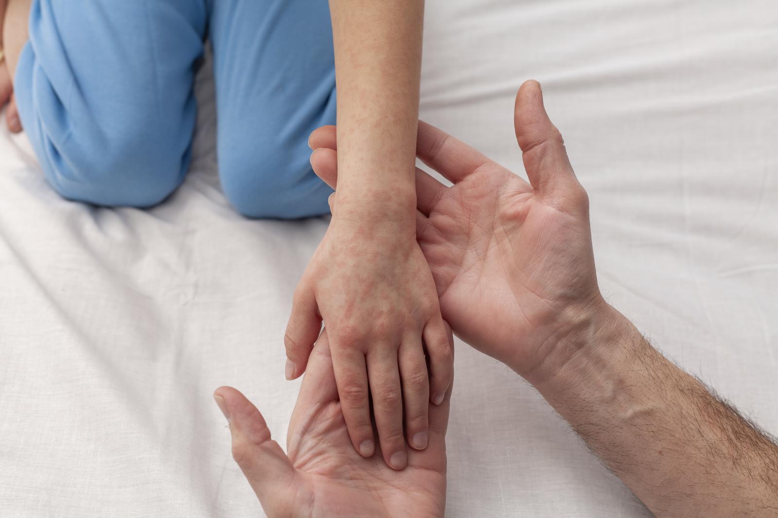 Singapore confirms measles case in 11-month-old girl; first involving child in preschool since stepped-up measures