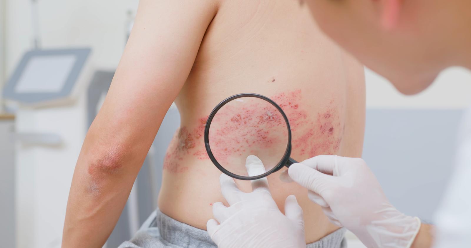 Shingles vaccine linked to fewer heart attacks and strokes, study suggests – what you need to know