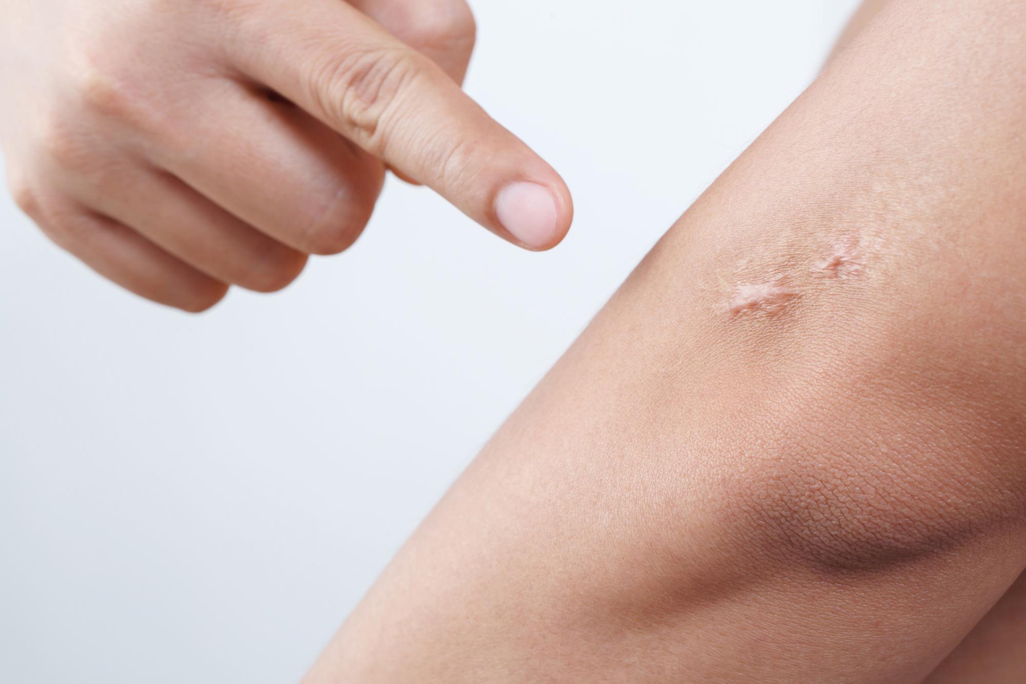 Can you make scars fade? Doctors explain why they form and what works – from silicone sheets to Vitamin E